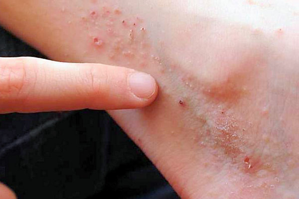 Dermatite atopique: ce qu'il est vraiment